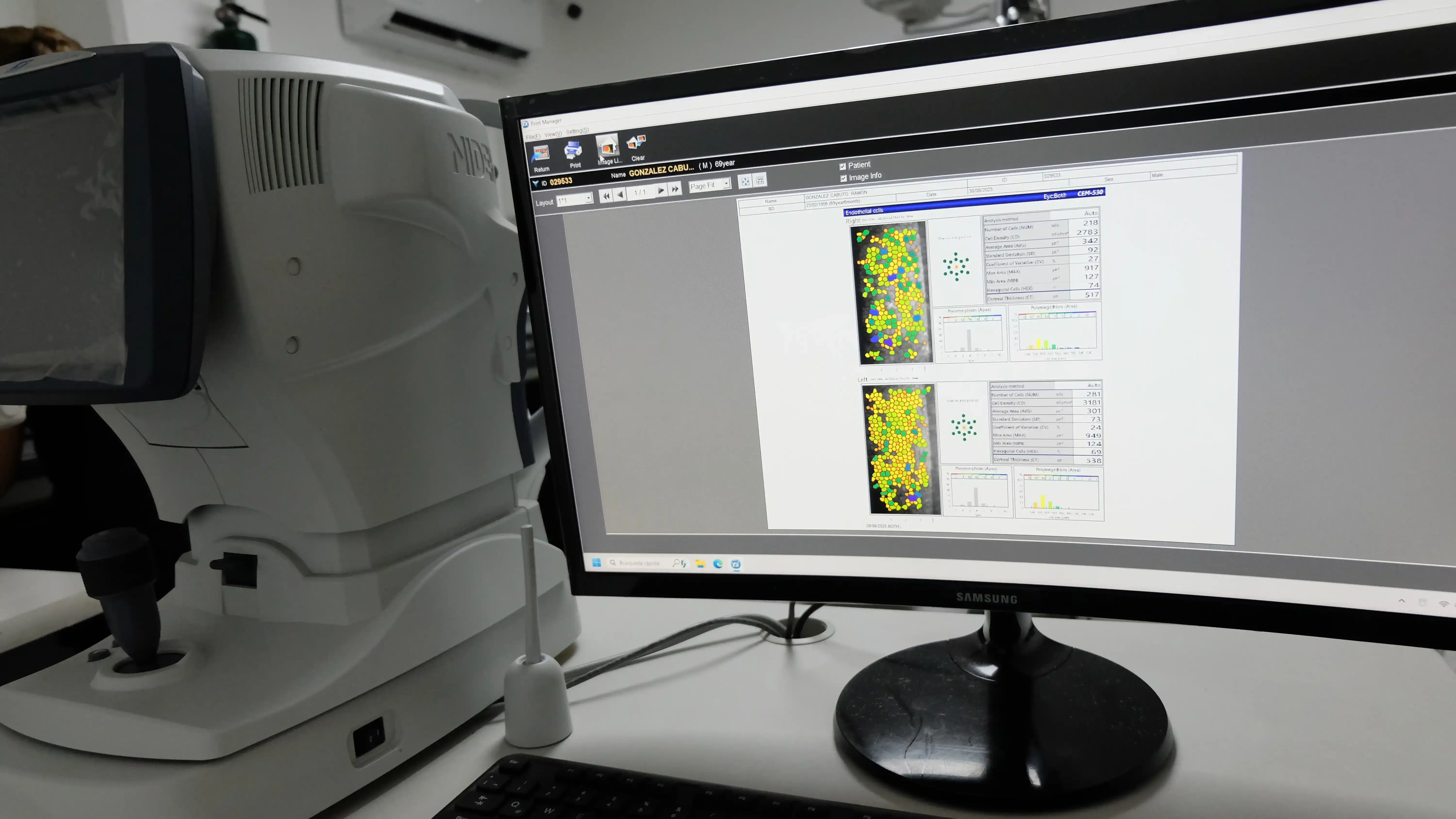 Oftalmólogo realizando un diagnóstico de catarata a un paciente.