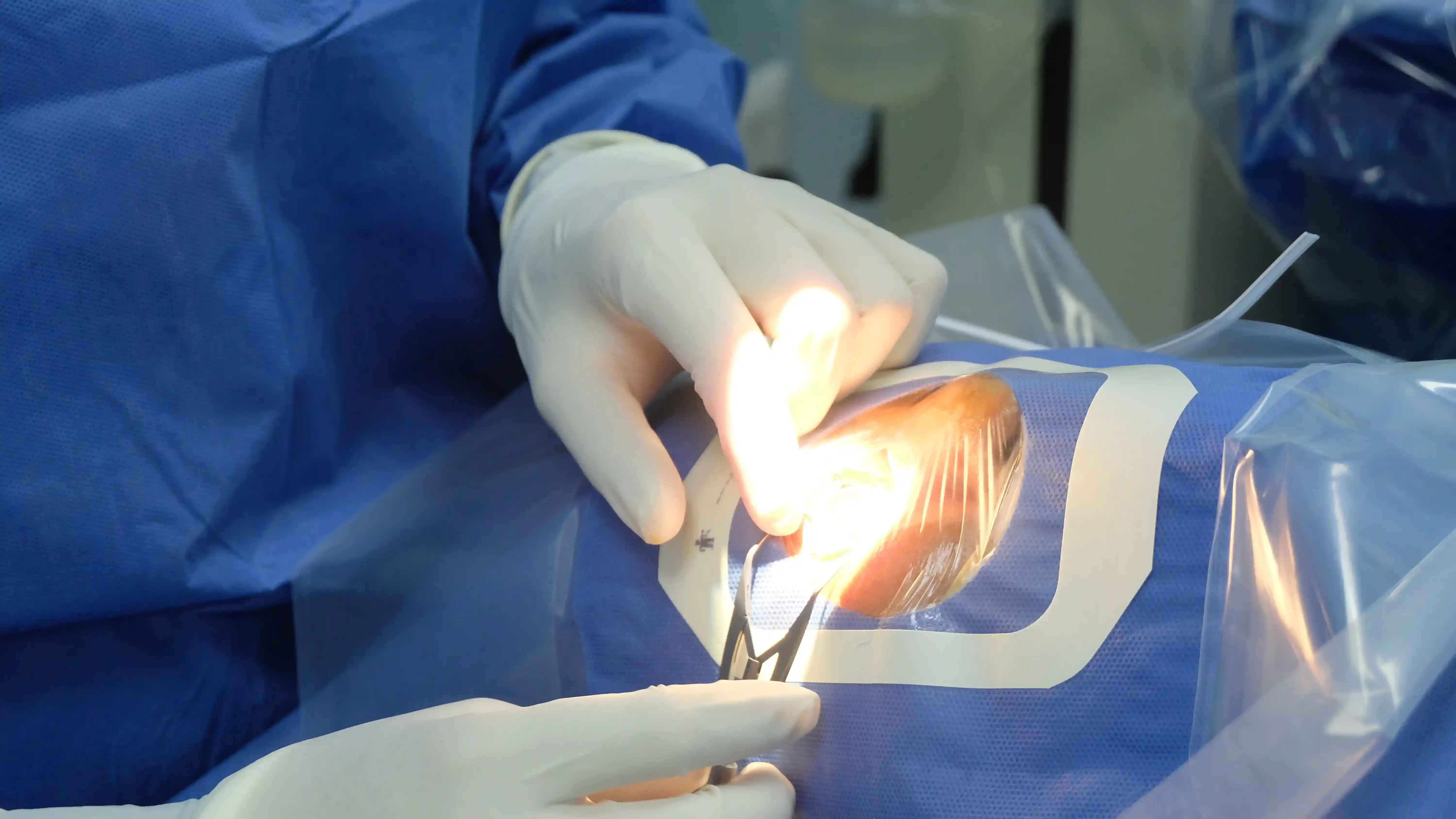 Ilustración de un implante de drenaje para glaucoma en el ojo.