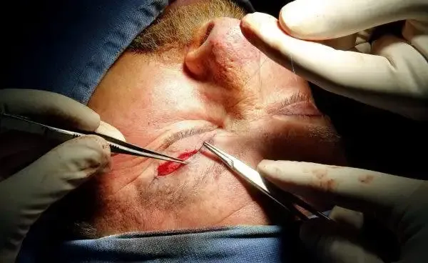 Diagrama mostrando las áreas de incisión en una cirugía de blefaroplastia superior e inferior