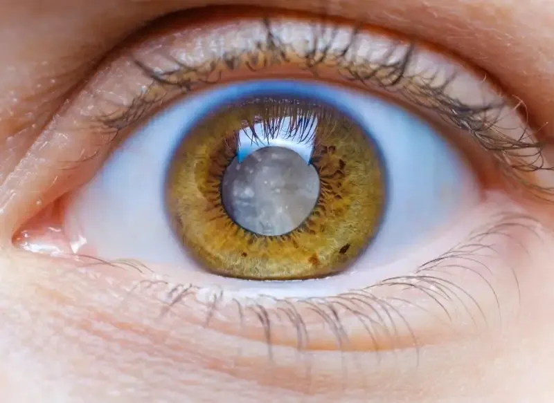 Vista microscópica de una cirugía de catarata, mostrando la precisión del procedimiento.