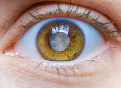 Oftalmólogo especialista realizando una cirugía de cataratas con equipo de última generación.