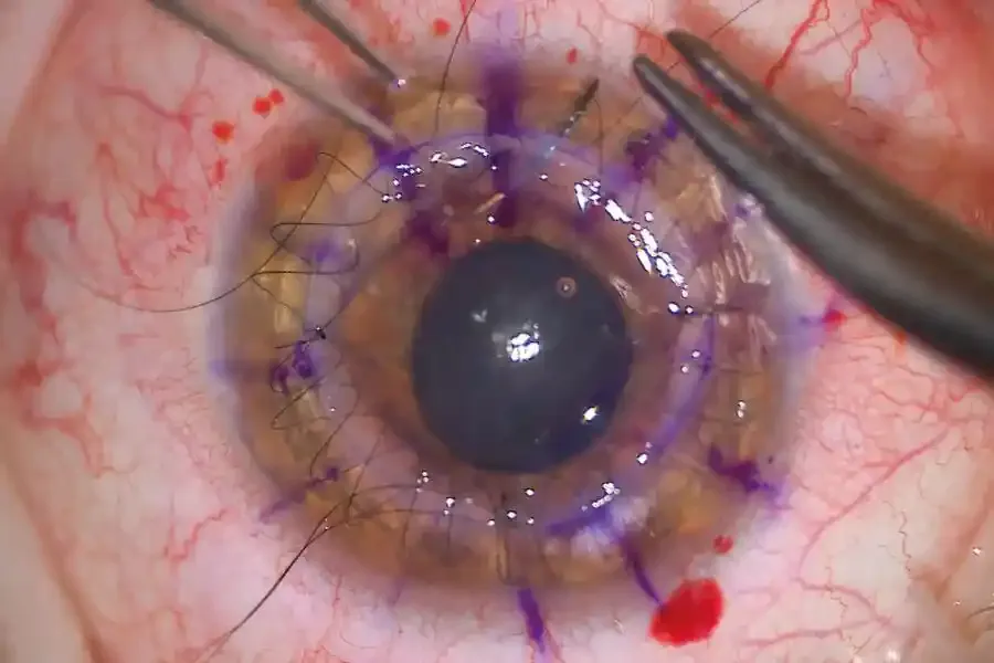 Vista microscópica de una cirugía de catarata, mostrando la precisión del procedimiento.