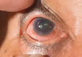 Visualización del nervio óptico durante un examen de glaucoma, destacando su importancia.