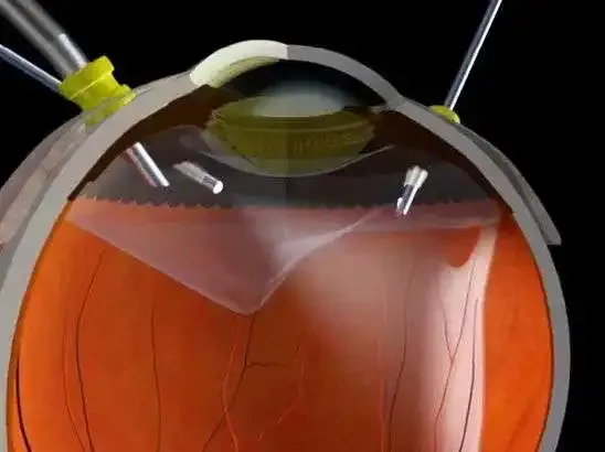 Representación gráfica de una cirugía de vitrectomía.