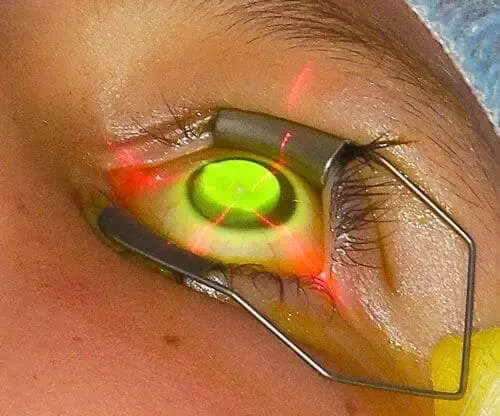 Procedimiento de crosslinking corneal