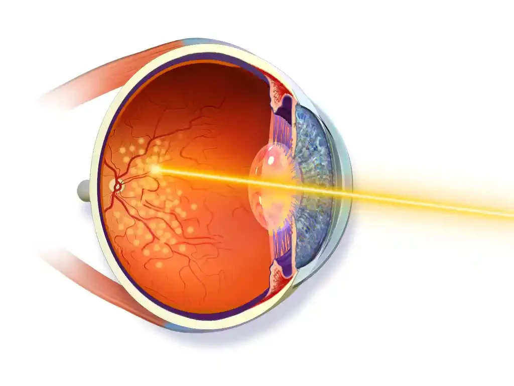 Ilustración de un procedimiento de fotocoagulación con láser en la retina.