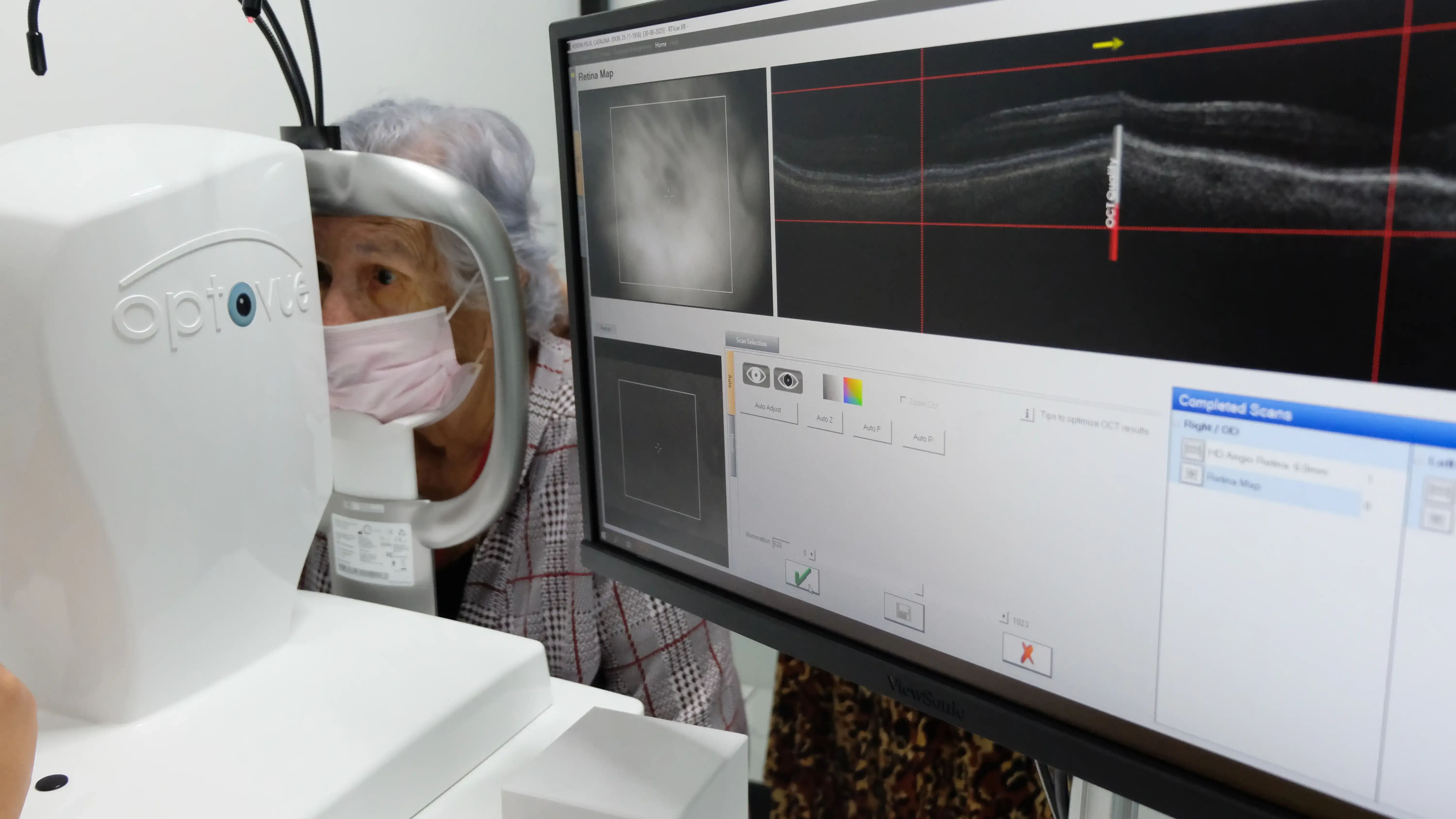 Primer plano de un ojo sano, mostrando un párpado bien posicionado y una piel saludable.