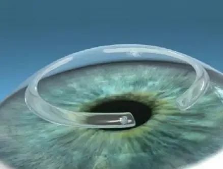 Diagrama de un segmento intraestromal implantado en la córnea