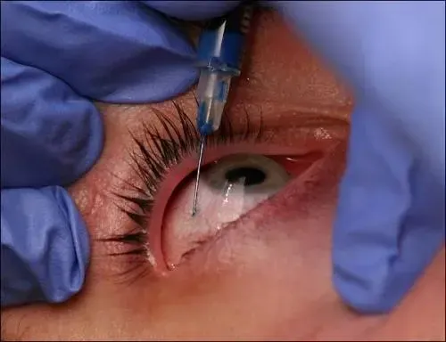 Diagrama ilustrativo del procedimiento de inyección intraocular para tratar la mácula