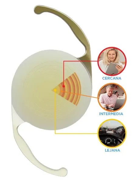 Diagrama de un lente multifocal mostrando sus anillos concéntricos y múltiples puntos de enfoque