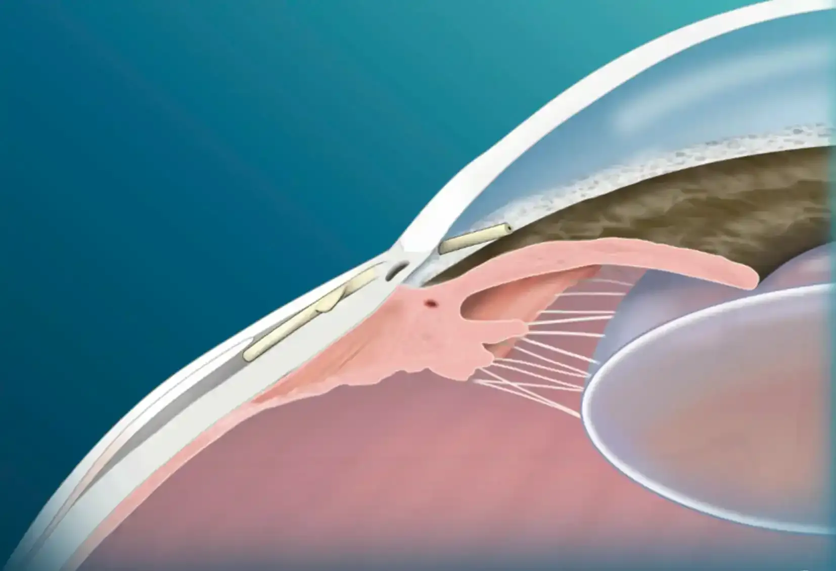 Esquema del implante PreserFlo MicroShunt y su función de drenaje en el ojo