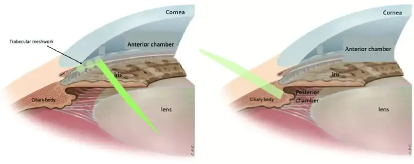 Diagrama que muestra la aplicación del láser de ciclofotocoagulación sobre el cuerpo ciliar