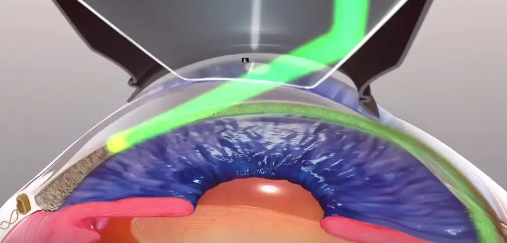 Ilustración que muestra la aplicación del láser SLT en la malla trabecular del ojo